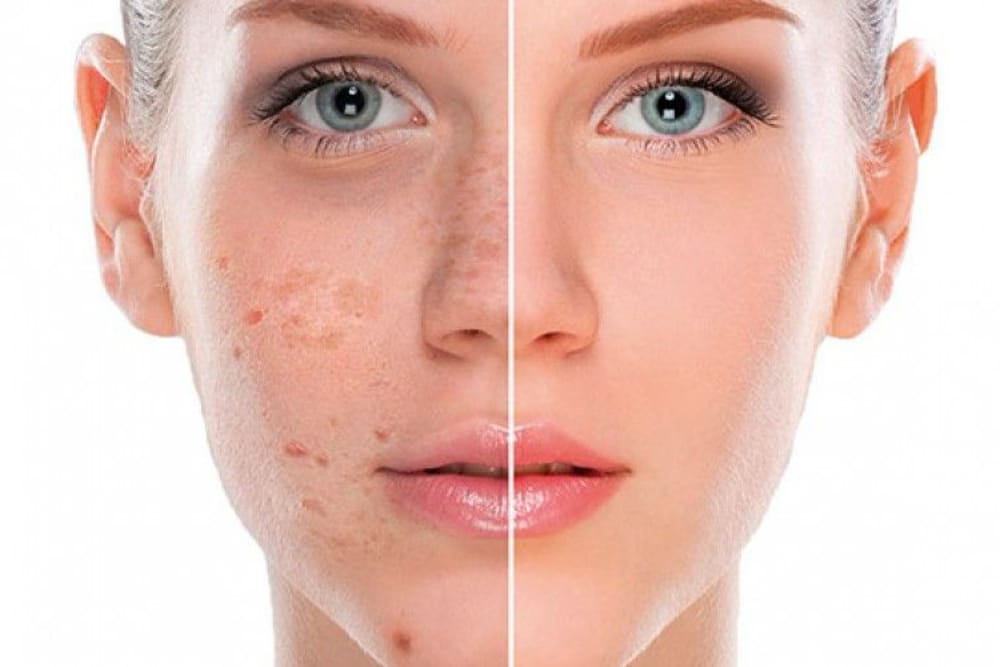 Hyperpigmentatie - Sima Skin Clinic