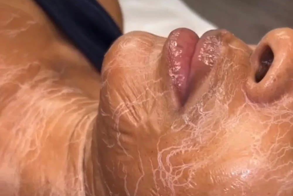 V-lift Max - Sima Skin Clinic